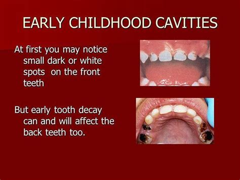 What Does A Cavity Look Like On A Child S Tooth What Does