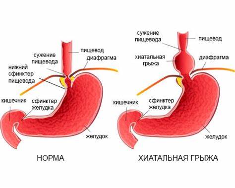 Диета от грыжи