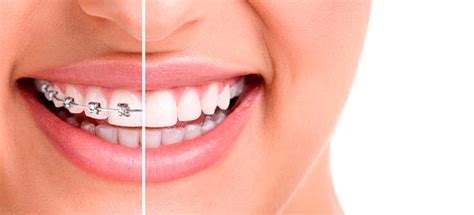 Ortodoncia Mitos Y Verdades Sobre La Sonrisa Perfecta