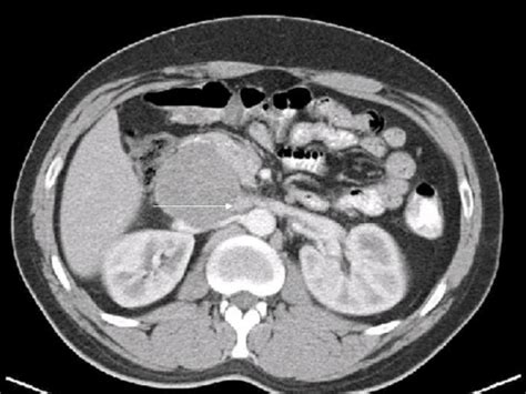 Abdominal Ct Scan Axial Contrast Enhanced Ct Image Showing A