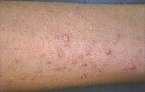 Follicular Eruption On Arms And Legs—quiz Case Dermatology Jama Dermatology Jama Network