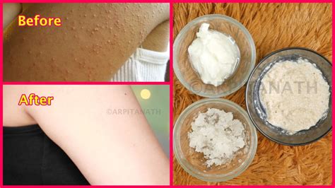 How To Get Rid Of Tiny Red Bumps Rashes From Face Arms Hips