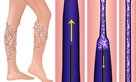 Sclerotherapy Why Doctors Choose This Treatment For Spider Vein Removal
