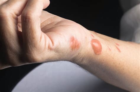 A Non Invasive Method Developed To Assess Burn Wound Healing Apn Live