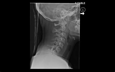 Cervical Spine Xr Fracture Subluxation C6 7 1 Of 6 Flickr