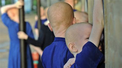 Malawi Albino Attack Survivor I Am Too Scared To Sleep Bbc News