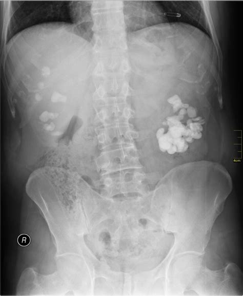 X Ray Or Ct Scan For Kidney Stone
