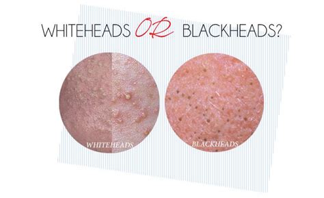 Treating Blackheads Whiteheads Advanced Dermatology Associates In