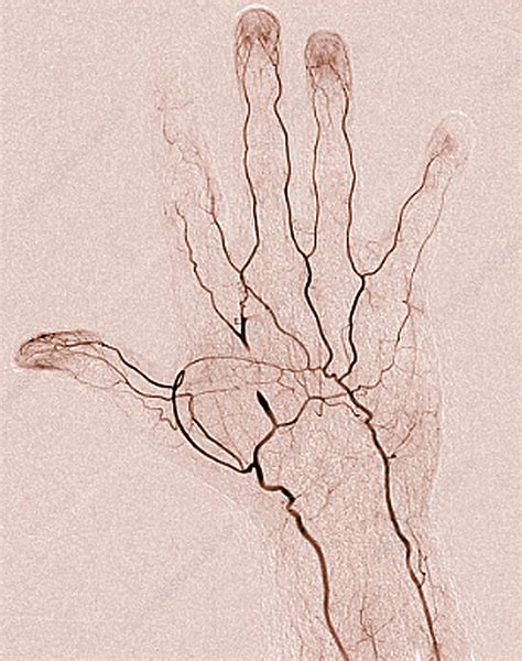 Blocked Hand Artery Angiogram Stock Image C0488754 Science