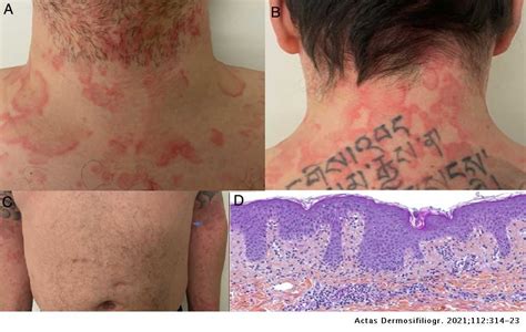 Cutaneous Manifestations In Patients With Covid 19 Clinical