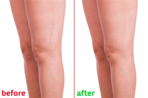 Do Spider Vein Removal Treatments Work Toronto Laser Clinic