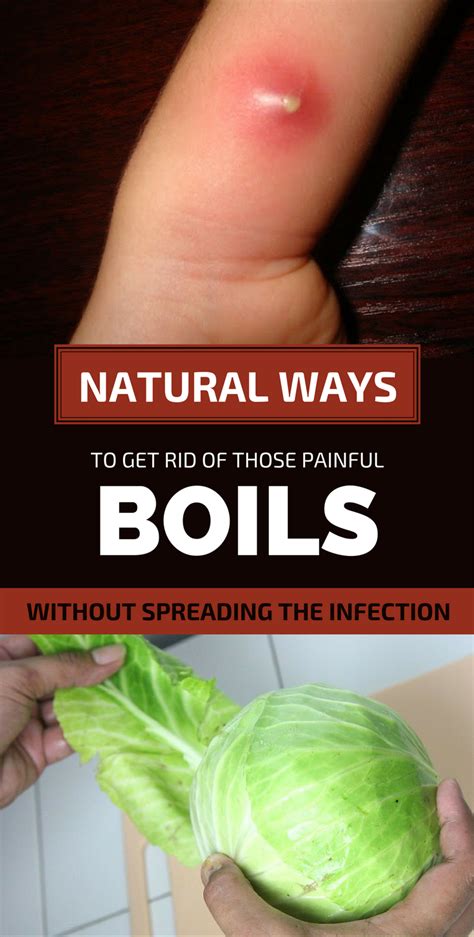 Natural Ways To Get Rid Of Those Painful Boils Without Spreading The