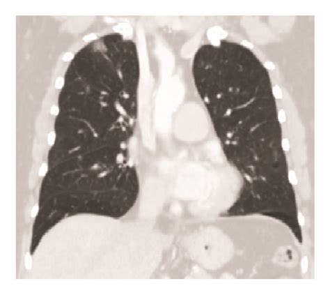 Rosai Dorfman Disease Rare Pulmonary Involvement Mimicking Pulmonary