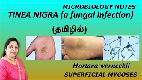 Tinea Nigra Superficial Mycoses Hortaea Werneckii Microbiology Notes Tamil Dr Blessy