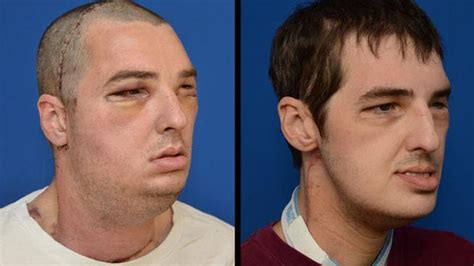 Full Face Transplant Patient Richard Lee Norris After Surgery