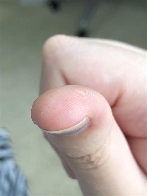Identifying A Painful Bump On Finger Pad Thriftyfun Vrogue
