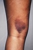 Bruise on Leg - Stock Image - C027/0657 - Science Photo Library