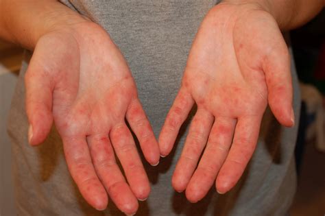 Can Adults Get Hand Foot And Mouth Disease
