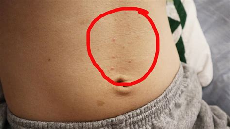Help Strange Bumps Re Appearing Above Belly Button The Bumps Are