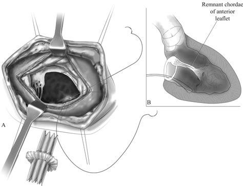Melody Valve For Mitral Valve Replacement Operative Techniques In