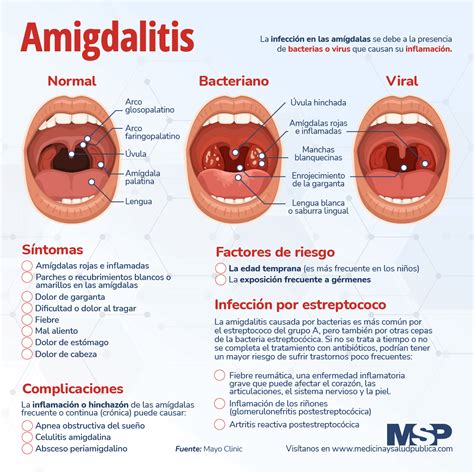 Arriba 102 Foto Diferencias Entre Amigdalitis Viral Y Bacteriana Alta