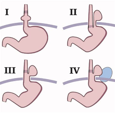 Figure 2 From Classification Of Hiatal Hernias Using Dynamic Three