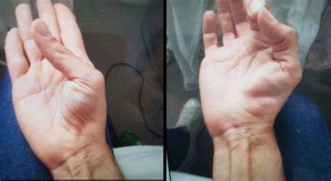 Weak Hand And Twitching Legs Practical Neurology