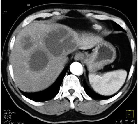 Multiple Liver Abscesses Liver Case Studies Ctisus Ct Scanning