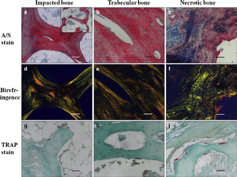 E Histology As Stain Of Impacted Bone Revealed A Trabecular Structure