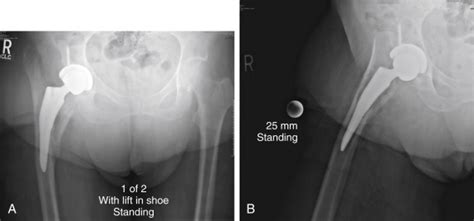 Direct Anterior Approach To Revision Total Hip Arthroplasty