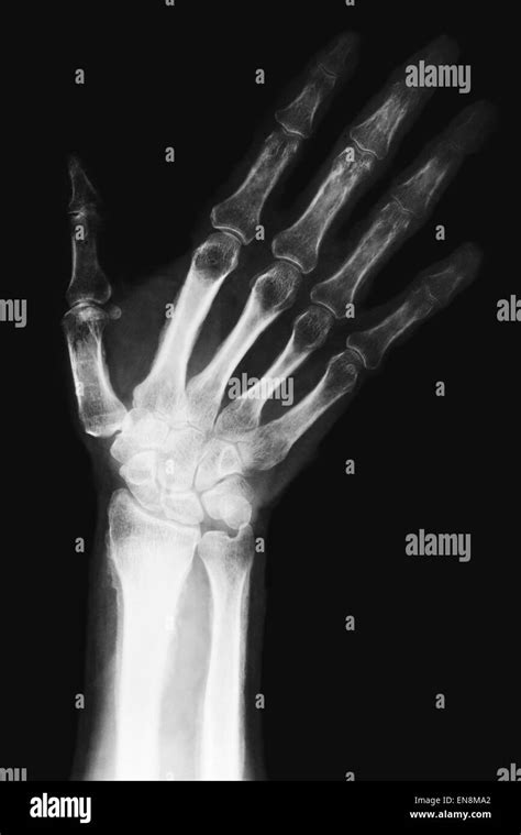 X Ray Distal Radius Wrist Fracture Hi Res Stock Photography And Images