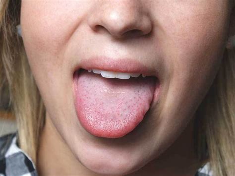 Try These Home Remedies To Get Rid Of Burning Tongue Newstrack English 1