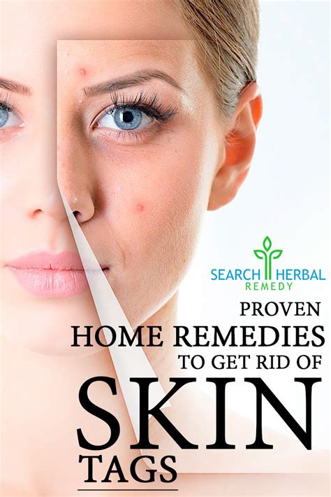 10 proven home remedies to get rid of skin tags search herbal and home remedy