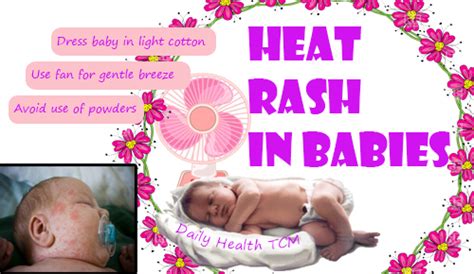 Heat Rash In Babies Daily Health
