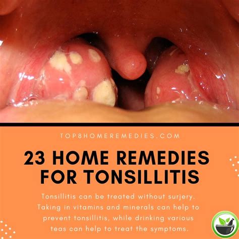 Mononucleosis Tonsils Remedies For Tonsils Swollen Point6 Tonsil