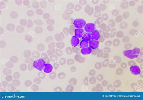 Group Of Blast Cells In Leukemia Background Stock Image Image Of