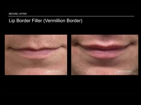 Lip Line And Lip Filler Siperstein Dermatology Group