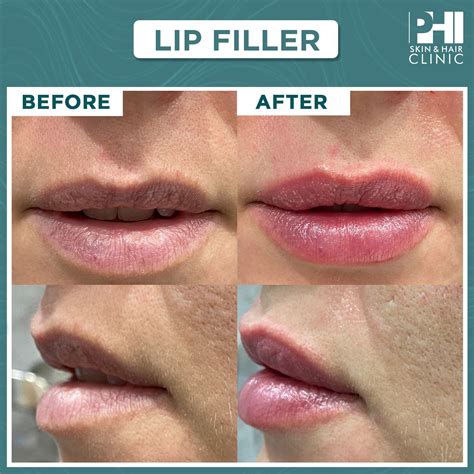 Stunning Lip Transformation Before And After