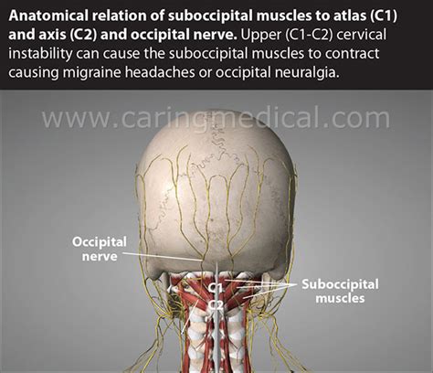 Occipital Neuralgia And Suboccipital Headache C2 Neuralgia Treatments