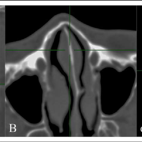 Computed Tomography Ct Scan Of The Paranasal Sinus Showing The Nasal