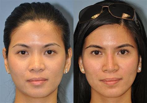 Non Surgical Rhinoplasty Chevy Chase Virginia And Washington D C