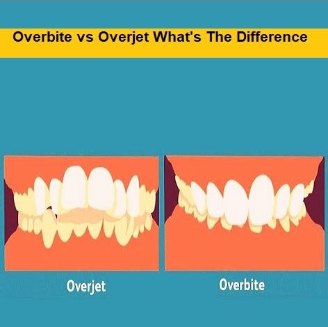 Overbite Vs Overjet What S The Difference Dentist Explained