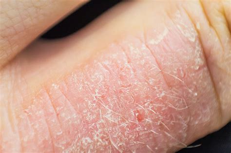 Hand Dermatitis Hand Eczema Stock Photo Download Image Now Istock