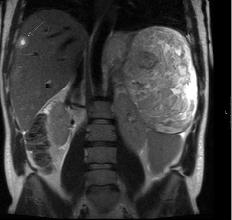 Coronal T2 Weighted Mri Hepatic Metastasis Visible In The Right Liver