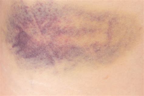 Hematoma Causes Symptoms Types And Treatment