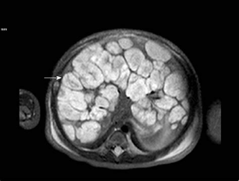 Diffuse Infantile Hepatic Hemangiomas T2 Weighted Axial Mri Image Of A