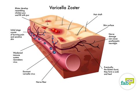 How To Treat Shingles Herpes Zoster And Get Rid Of Pain And Infection