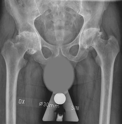 How Different Hip Problems Are Solved With Hip Resurfacing
