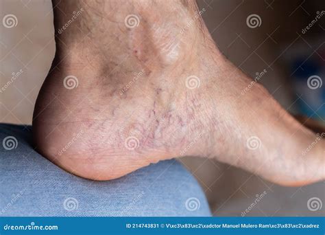 Adult Man S Foot With Varicose Veins Stock Image Image Of Body
