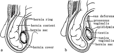 A Congenital Indirect Inguinal Hernia And B Acquired Indirect